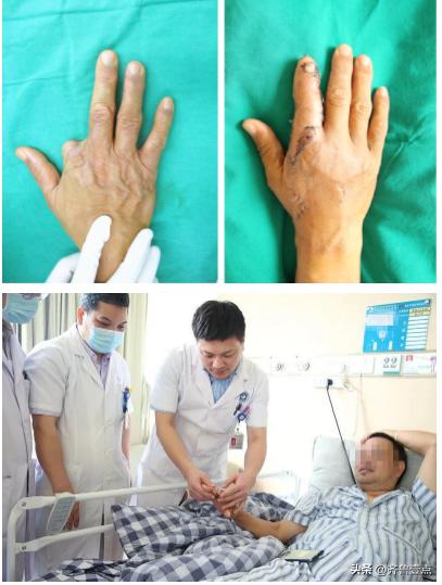 手指缺失10級(jí)傷殘圖九級(jí)傷殘一共賠幾萬(wàn)插圖 手指缺失10級(jí)傷殘圖九級(jí)傷殘一共賠幾萬(wàn)插圖